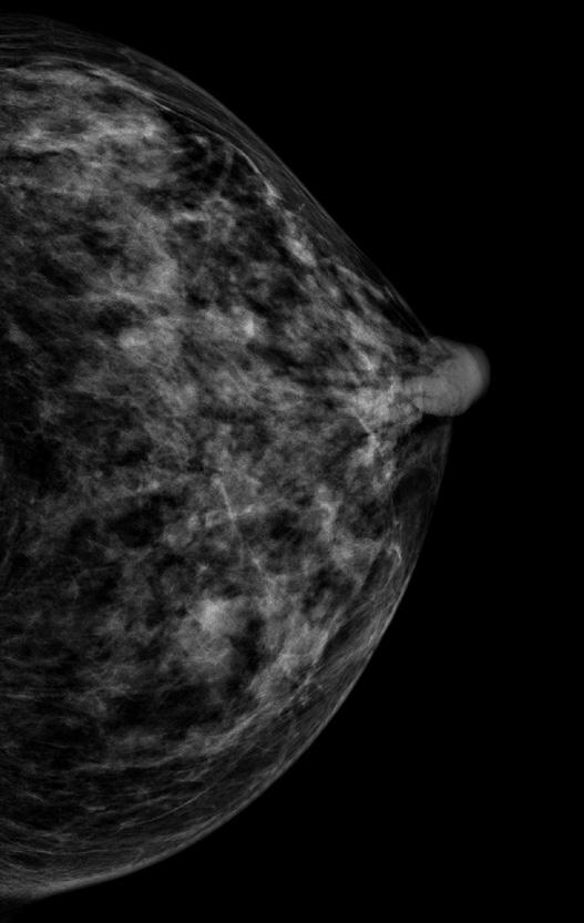 가장흔한진양성증례는침윤성종괴였다 (Fig. 2). 수련군의 A B Fig. 4. A 56-year-old healthy woman. Right mediolateral oblique (MLO) view (A) shows negative finding.