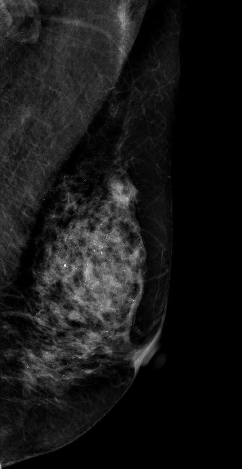 Additionally, diffusely scattered calcifications were evident in both breasts. It was the most common false-positive case: 46.3% of trainees and 40.