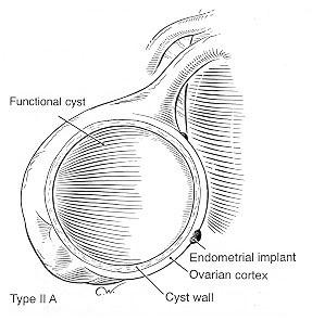 Cyst size가클수록가능한한 cyst wall의 laser or electrocoagulation보다는 cyst wall의 stripping 이좋다. Cyst wall stripping 의완전한제거가능성때문에 Beretta P 등 (1998) 은두수술방법의비교에서수술후 dysmenorrhea (15.8% vs 52.