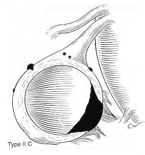크기는대개 3-20 cm 정도되고낭종벽의대부분에서자궁내막조직이발견되는것이보통이며낭종의박리가역시잘안되는특징이있다.