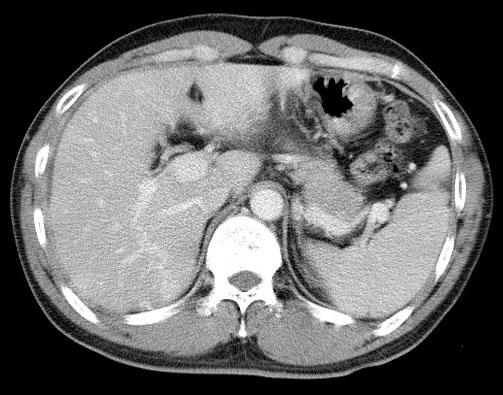 백현철외 7 인. 남자에서발생한 Fitz-Hugh-Curtis Syndrome 1 예 205 Fig. 3. Abdominal CT finding. Six weeks after treatment, the enhancement of liver capsule over the right lobe disappeared completely.