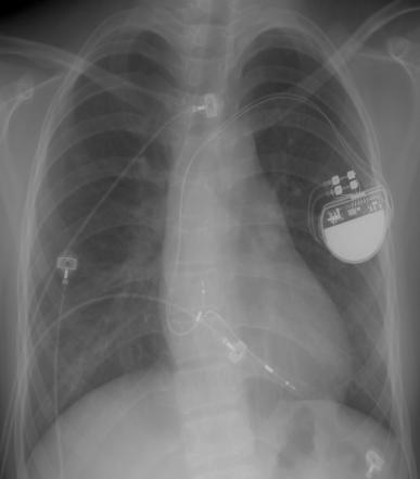 CASE 7-5 DDD pacemaker implantation 05, Jung