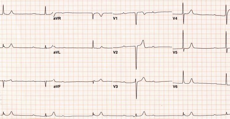 CASE 8-2 EKG at old chart 05, Tak