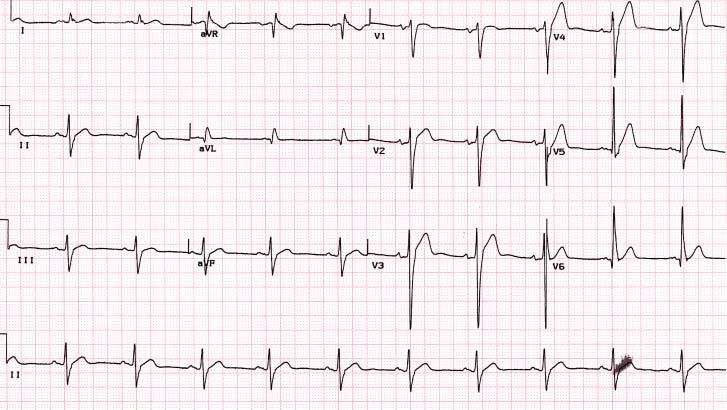 CASE 10-6 ECG after cardioversion 05, Kim DK, #
