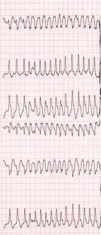 CASE 13-1 20/M ( ) Palpitation for 15 hours -