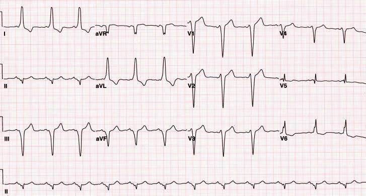 CASE 14-1 51 F, Referred for EKG abnormality