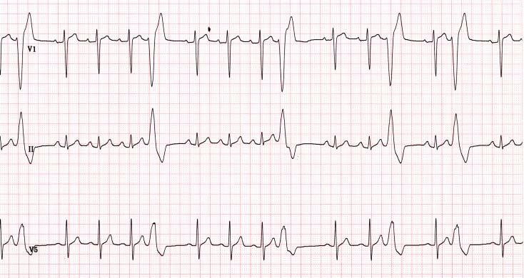 CASE 3-1 41 M Abnormal ECG, HTN for