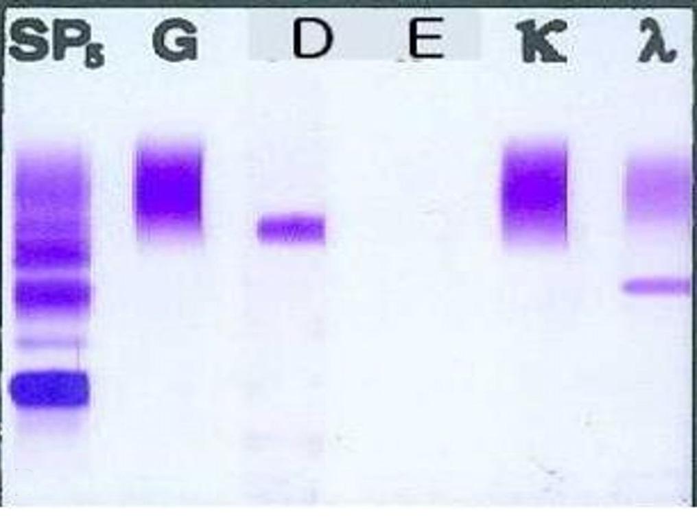 - yeong Kyu Park, et al. Retroperitoneal plasmacytoma - 병색을보였다. 혈압 150/90 mmhg, 맥박수 90회 / 분, 호흡수 20회 / 분, 체온 36.8 였다. 흉부청진상심음은규칙적이었고, 심잡음이나수포음은청진되지않았다. 복부팽만이있었으나압통과반발통은없었고장음은정상이었다.