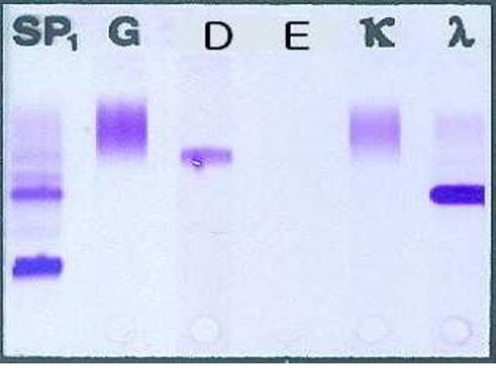 5 mg/dl였다. 혈청칼슘 8.6 mg/dl, 인 3.9 mg/dl, 요산 12 mg/dl, 젖산탈수소효소 (lactate dehydrogenase, LDH) 2512 IU/L ( 정상범위 : 100-450 IU/L) 로 LDH가 뚜렷하게상승되어있었다. 프로칼시토닌 0.13 ng/ml, C-반응성단백 (C-reactive protein) 5.