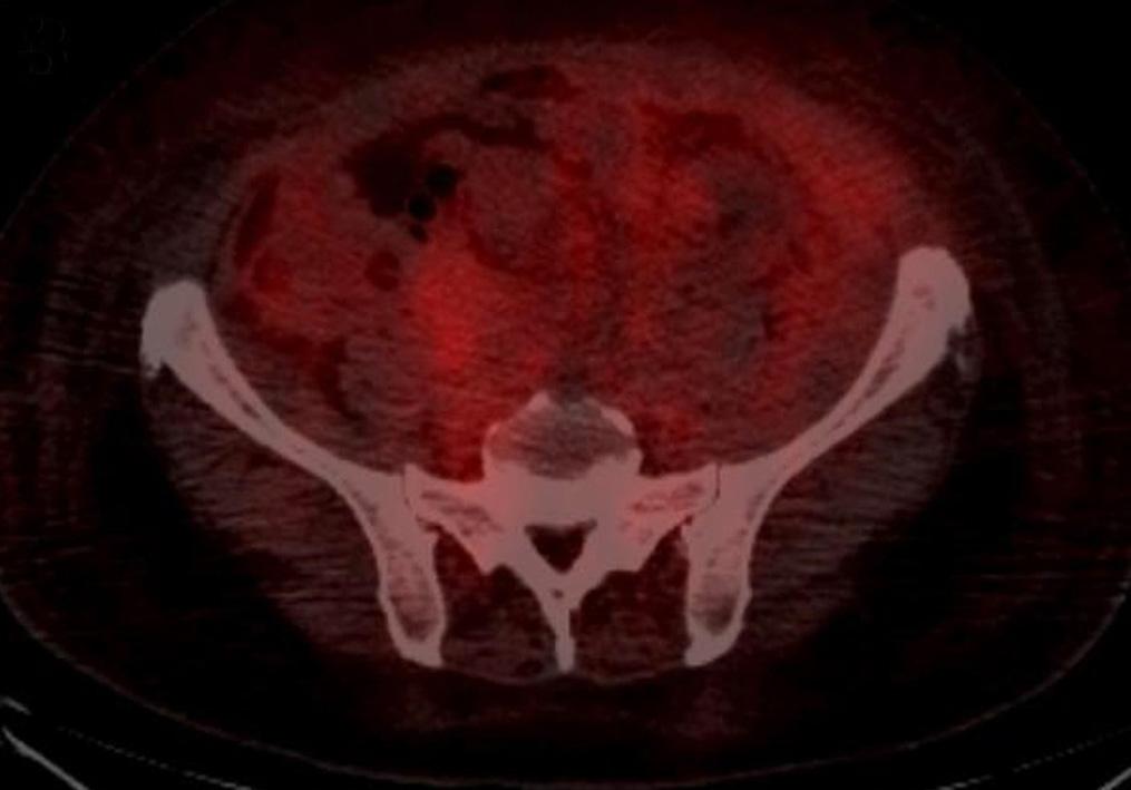 tomography showed diffuse fludeoxyglucose