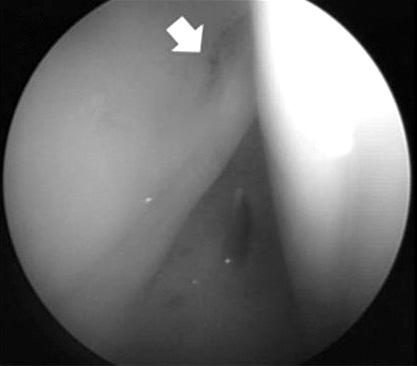 495 The Current Concepts of Hip rthroscopy FH L FH B Figure 14. cetabular labral tear by iliopsoas impingement is located more anteriorly than that by femoroacetabular impingement.