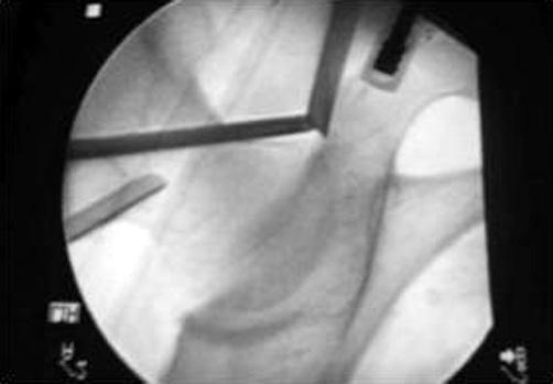 488 Pil-Sung Kim and Deuk-Soo Hwang Figure 6. Fluoroscopic image of the medial portal. 구부위에서 3개이상의가지로나뉘게되어전방삽입구는이가지사이로지나가야한다. 외측대퇴회선동맥 (lateral femoral circumflex artery) 은보통전방삽입구의하부로 3.
