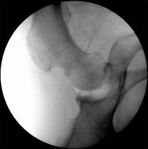 489 The Current Concepts of Hip rthroscopy B C D Figure 7. Serial fluoroscopic images of the classic portal insertion method in the central compartment.