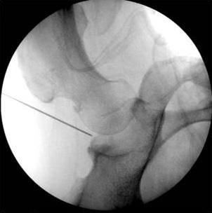 (C) s obturator is inserted into the joint, the operator can identify successful insertion of the spinal needle by the shape of the spinal needle under fluoroscopy.