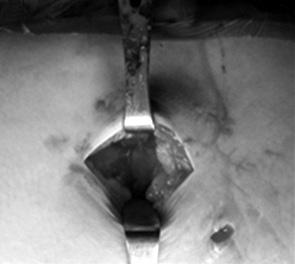 The harvested iliotibial band (triangle) was transferred and repaired on acetabular margin for labral defect.