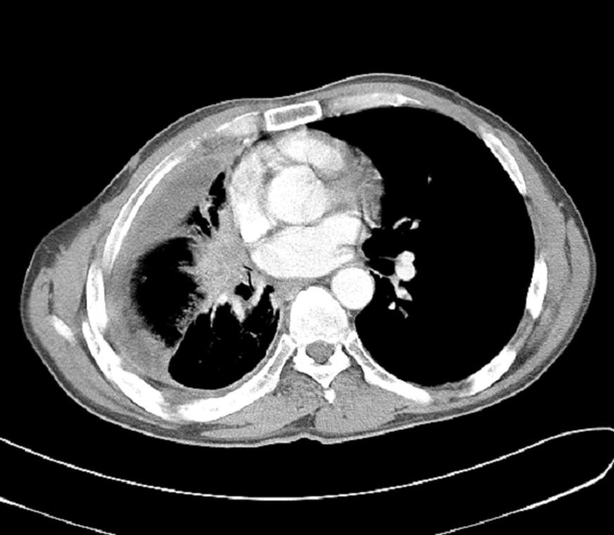 대흉외지 2004;37:937-941 Fig. 1. Preoperative chest CT shows pleural effusion in the right hemithorax and collapsed right lung. Also shows multiple nodules in the parenchyme of left lung. 로 보고되었다.