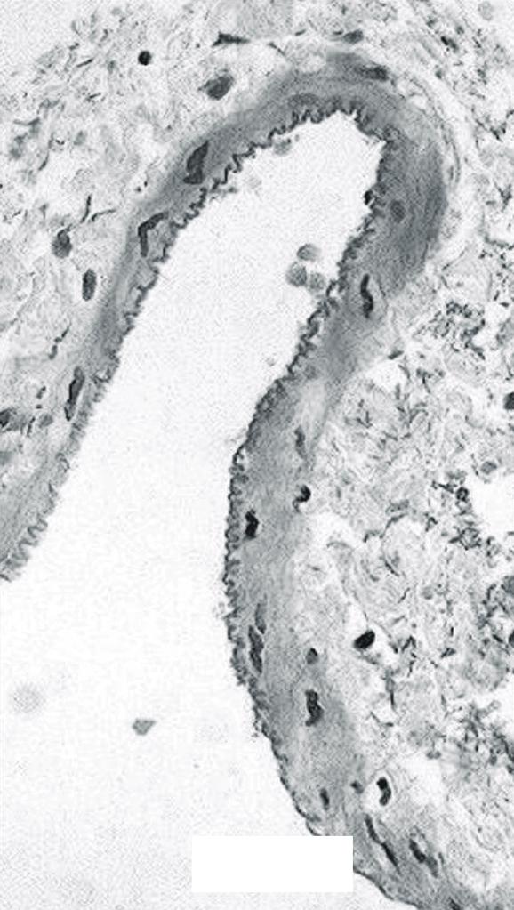 혈전 후 발생되는 혈관벽의 비후가 임상적으로 주목을 Table 2. Infiltrating neutrophil number in intima & media of experimental rat veins Table 3.