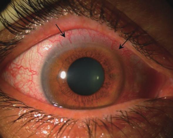 Kang B-H, et al. Ocular Ischemic Syndrome: Current Treatment 이없는부분이다 (Fig. 4). 따라서중심오목을포함하여망막의광수용기층은맥락막혈관층에서혈액공급을담당한다.