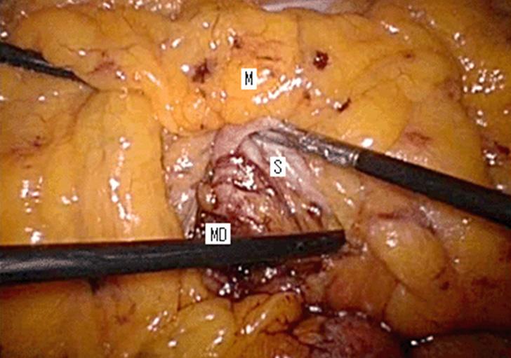PS = Peterson s space. Fig. 4. Antecolic-antegastric gastro-jejunal anastomosis.