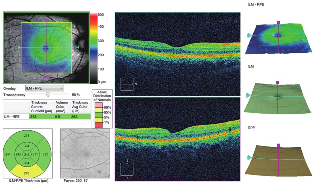 B A Fig. 4. (A) Peripapillary retinal nerve fiber layer analysis map. (B) Macular ganglion cell analysis map.