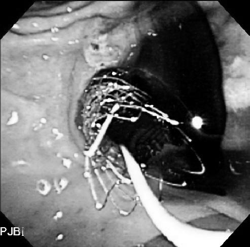 chest X-ray 실시하고다음날은