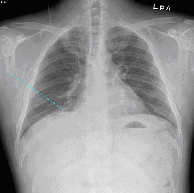 opacity in right lower lung zone(arrow), which suggests