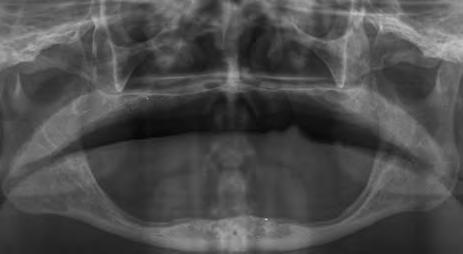 Panoramic X-ray showing severe bone resorption of both arches. Maxilla with flabby tissues and flat vault. 죽한외모를가지고있었다.(Fig.