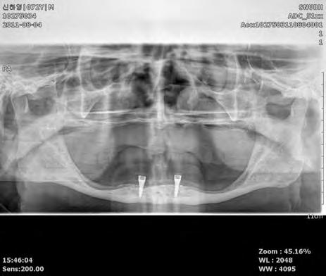 Yi YJ, Kim YK: Atrophied bone restored with mini-implant 17 다.(Fig.