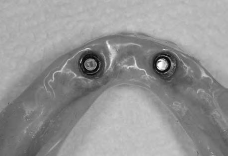 Two mini-implants were inserted to atrophied mandible.