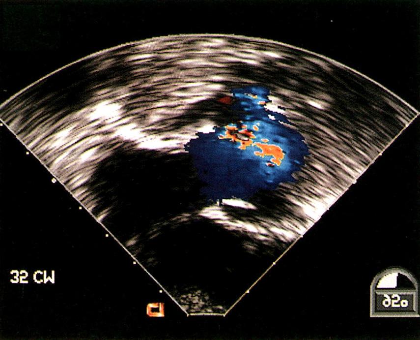 echocardiogram showing blood flow from aortic root into the aneurysm (B). A B Fig. 6.