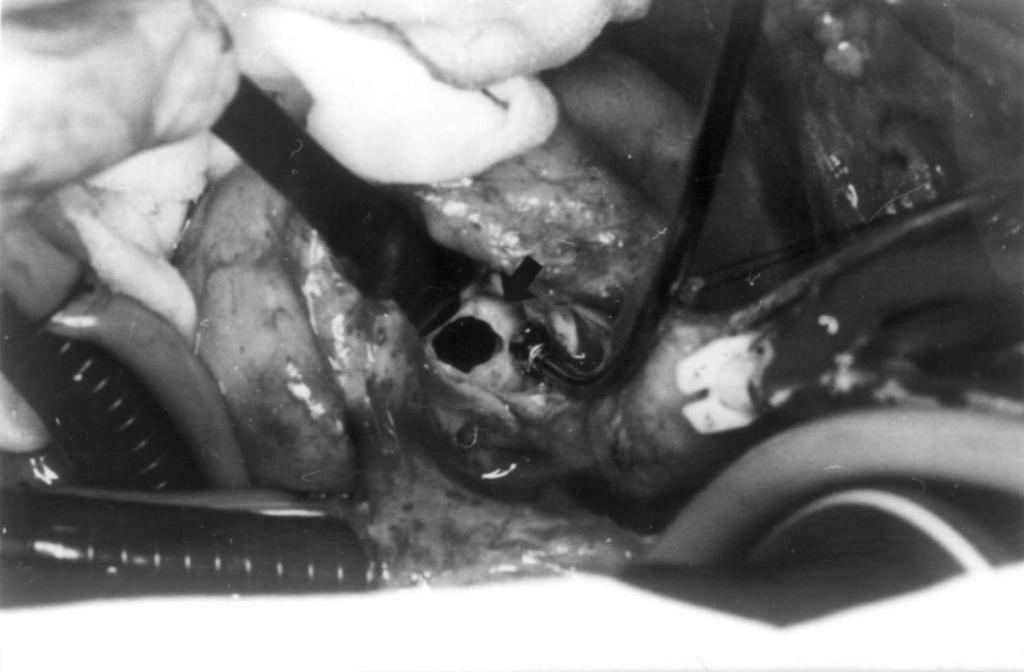 었다. 대동맥아래로는 심한 섬유화를 동반한 10mm의 는 2.39m/sec, 좌심실 유출로와 대동막 판막의 압력 대동맥하 막형성이 있었는데, 대동맥을 통하여 이를 차가 23mmHg로 현저히 감소되었으며(Fig. 5) 인공 모두 제거하였고 St. Jude 29mm로 승모판 대치수술 판막의 기능은 정상이었다. 현재 환자는 항응고제 및 을 시행하였다(Fig.