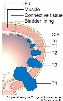 [ 그림 13] 종양병기에따른방광암의구분 표재성방광암은비교적예후가좋은편이나, 해부학적구조및수술기법상의특징 으로매우재발이잦으며, 표재성방광암환자의 20% 정도는추적관찰중침윤성 방광암으로병기가진행함. 침윤성방광암은병기가매우세분화되어있고, 다른기관으로의전이여부가환 자의예후를결정하는중요요소임.