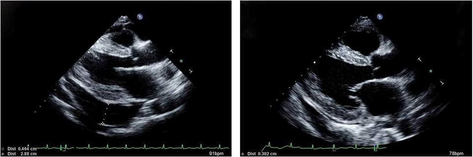 - The Korean Journal of Medicine: Vol. 78, No. 2, 2010 - A B Figure 1. Echocardiography image. Preoperative long-axis view (A) shows a large volume of pericardial effusion.