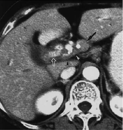 lesion on the right side of the portal  (C, D) CT scans (D obtained at a lower level than
