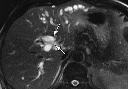 (C) Axial thin slab T2W HASTE MR (T2 weighted Half-fourier acquisition single shot turbo spin echo magnetic resonance) image shows dilatation of the bile duct (arrows).