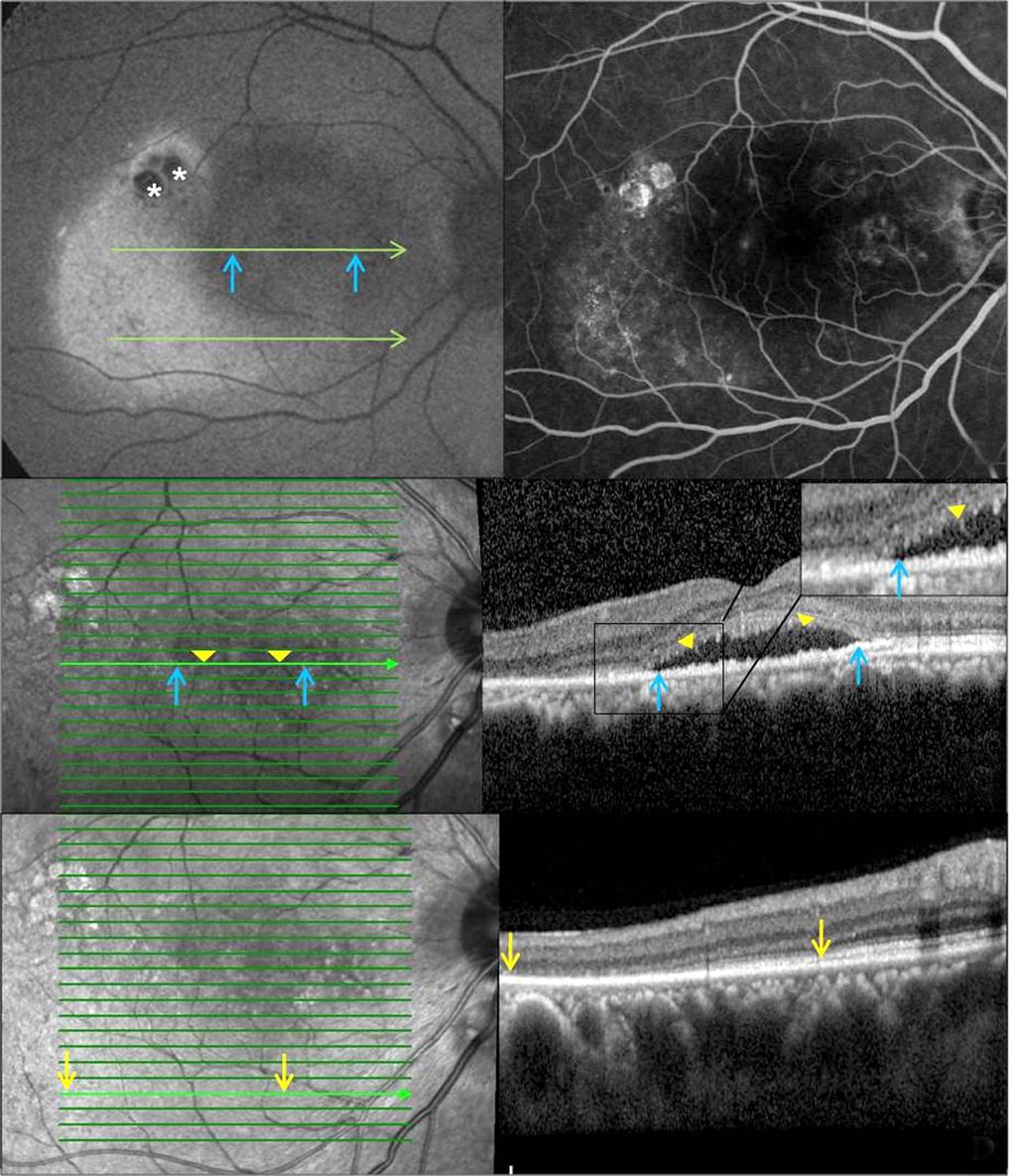 - 오인석 장지혜 : 만성중심장액맥락망막병증에서의망막외층변성 - A B C D Figure 5. Patient with 12-month history of central serous chorioretinopathy in the right eye after focal laser photocoagulation (Case 9).