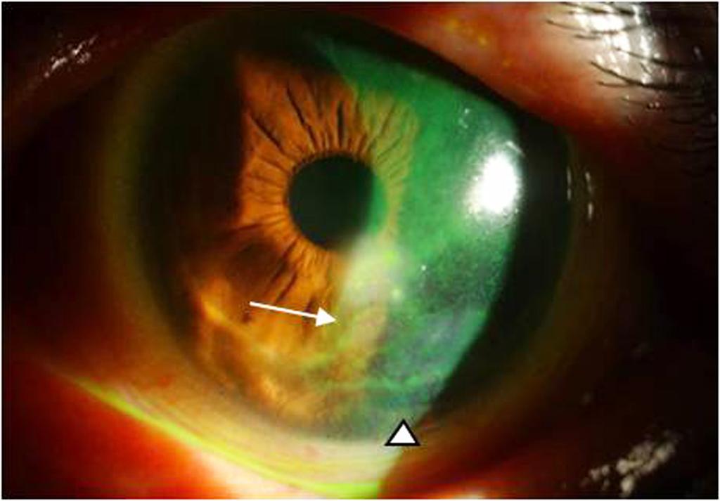 - 대한안과학회지 2012 년제 53 권제 7 호 - A B Figure 1. (Case 1) Anterior segment photograph of the left eye at initial visit.