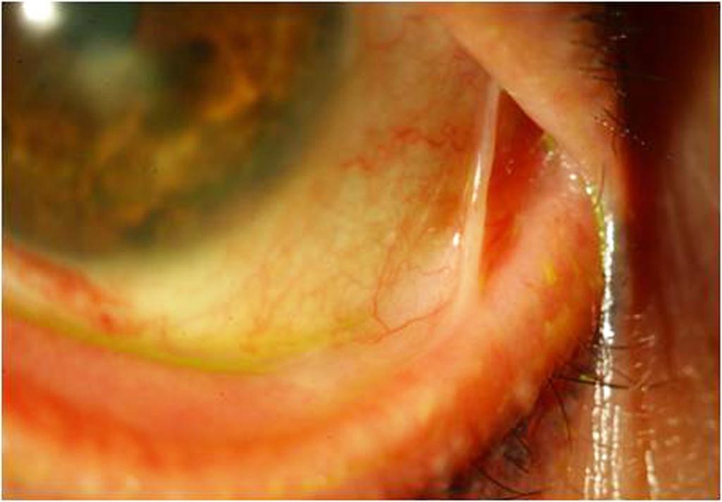 (Case 1) 1 week after amniotic membrane transplantation and symblepharon removal on left eye. Corneal ulcer and diffuse punctate erosion were improved.