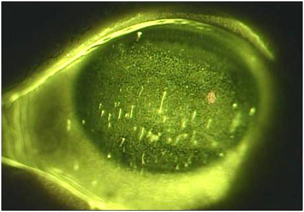 (Case 2) Anterior segment photograph of left eye at initial visit.