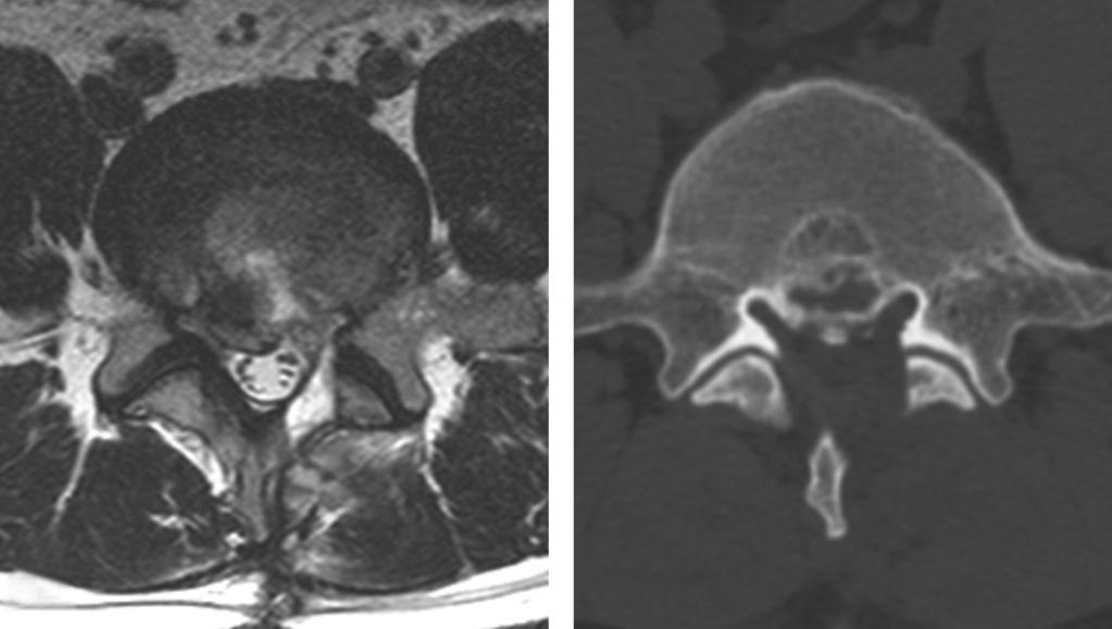 Woo Dong Nam et al Volume 22 Number 3 September 2015 Fig. 3. (-) Postoperative MRI and CT show a decompressed left lateral recess.