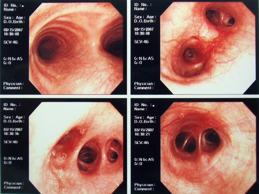 - Ja Kyung Kim, et al. A case of pneumonitis induced by gasoline intoxication - 증 환자 : 박, 20세남자주소 : 흉부불편감과호흡곤란현병력 : 평소건강하게지내며군복무중이던 20세남자환자가가솔린을옮겨담던중약 20 cc 정도의가솔린을마신후 3시간만에발생한흉부불편감과호흡곤란을주소로 Figure 1.