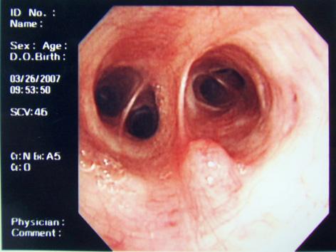 고 찰 Figure 5. Follow-up bronchoscopic image shows normal mucosa with a small nodule in the right middle lobe bronchus. 병리학적소견 : 세척액검사결과백혈구 300/mm 3, 적혈구가다량관찰되었으며병리소견상폐포울혈소견 ( 그림 3) 을나타내었다.