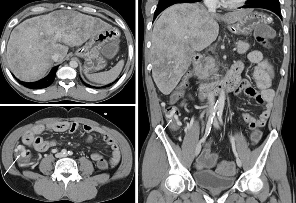 - The Korean Journal of Medicine: Vol. 75, No. 2, 2008 - A C B Figure 1. Abdominal CT, portal venous phase. (A) Severe hepatomegaly and diffuse periportal fatty infiltration are noted.