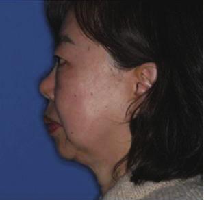 nasal cavity, which decrease orbital volume and pressure (C).