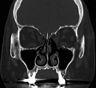 4. Preoperative xial CT scan (case 2) shows the distinct