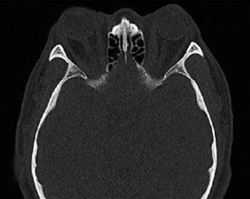 Three Wall Orbital Decompression Song J, et al. C D Fig. 6. Preoperative xial CT scan (case 3) shows the distinct exophthalmos in both eyes ().