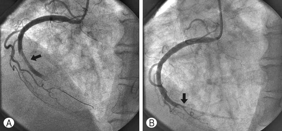 right coronary artery; and (B) after thrombus aspiration, balloon dilation, and stent insertion, thrombus (arrow) remained but thrombolysis in myocardial infarction grade 2 flow was observed.