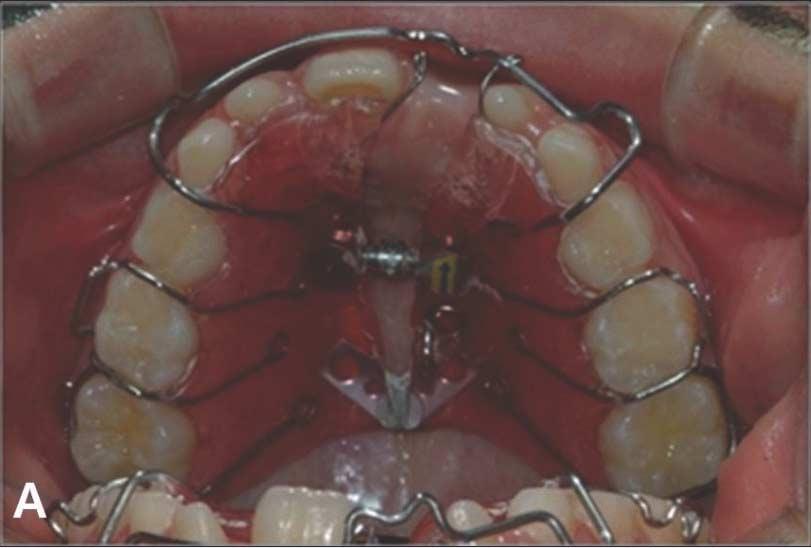Initial intraoral frontal