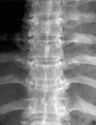 125 Figure 1. (A, B) Anteroposterior (A) and lateral (B) radiographs show 10% anterior height loss of the T7 vertebral body.