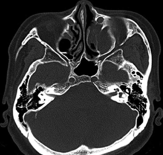 sinuses with increased pneumatization of contralateral sinus toward the aplastic side.